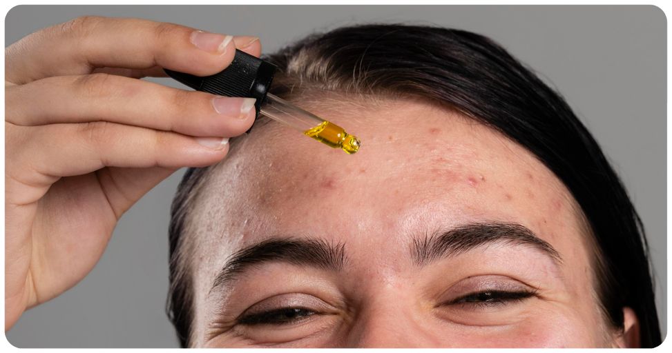 CBD et Acné : une solution naturelle pour une peau saine ?